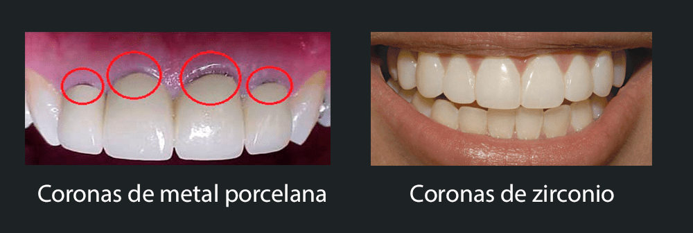 Diferencias entre las coronas de zirconio y de 100% porcelana