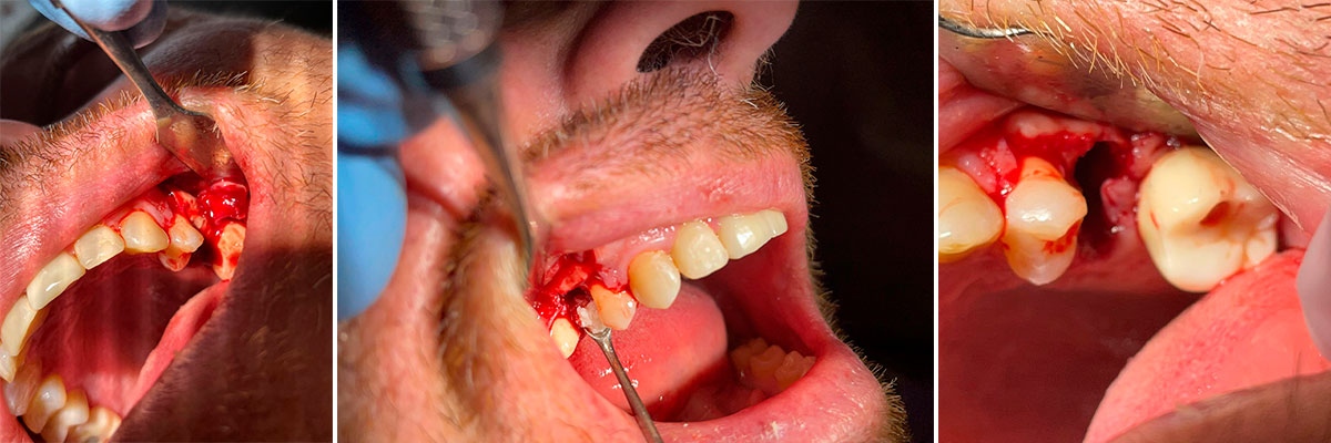 extracción dental mairena del aljarafe